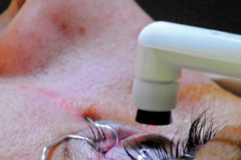 A close up view of an eye held open for eye surgery